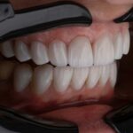 breakthrough-bioengineered-tooth-implants-mimic-natural-sensation