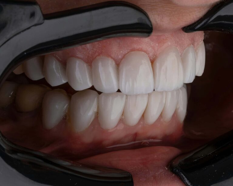 breakthrough-bioengineered-tooth-implants-mimic-natural-sensation