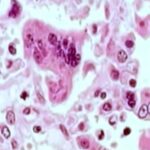 measles-outbreak-declared-in-grand-traverse-county-1