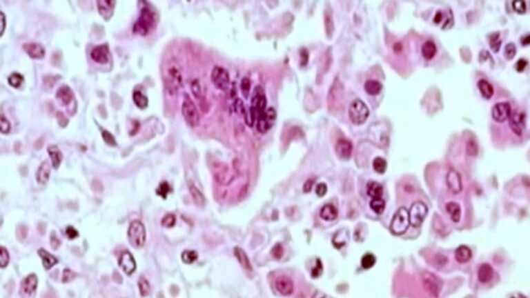 measles-outbreak-declared-in-grand-traverse-county-1