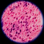 typhoid-fever-s-growing-antibiotic-resistance-alarms-experts