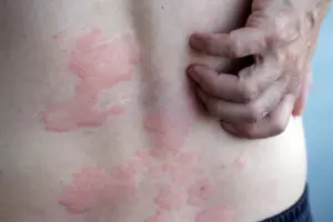global-study-reveals-effective-treatments-for-chronic-hives