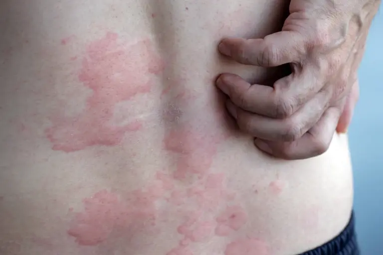 global-study-reveals-effective-treatments-for-chronic-hives