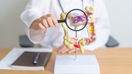 pds-biotechnology-completes-recruitment-for-colorectal-cancer-trial