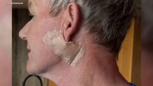 gordon-ramsay-undergoes-urgent-surgery-for-skin-cancer-removal