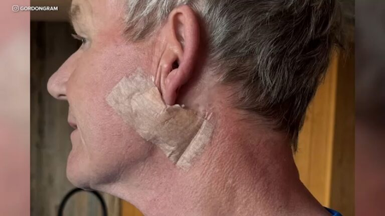gordon-ramsay-undergoes-urgent-surgery-for-skin-cancer-removal