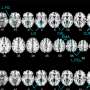 new-imaging-study-reveals-genetic-links-to-depression-in-young-adults