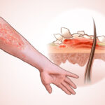 psoriasis-insights-5-lifestyle-changes-to-manage-symptoms