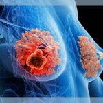 researchers-develop-innovative-control-arm-to-speed-her2-trials