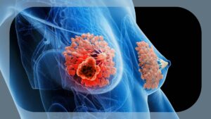 researchers-develop-innovative-control-arm-to-speed-her2-trials
