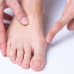 understanding-bunions-causes-treatments-and-recovery-insights