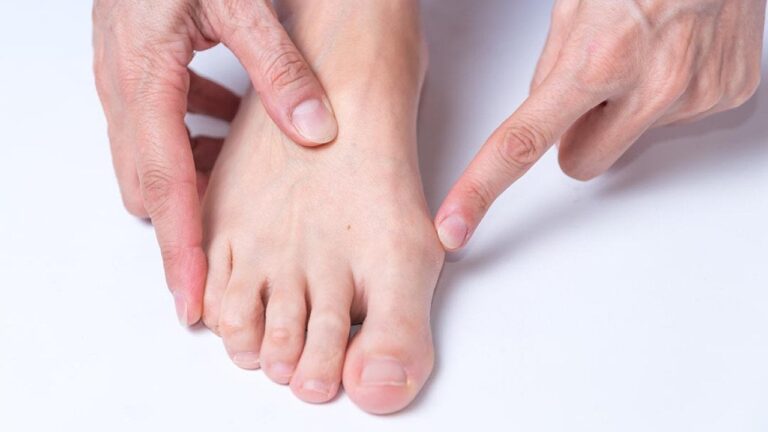 understanding-bunions-causes-treatments-and-recovery-insights