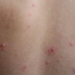 wisconsin-officials-warn-of-measles-exposure-at-travel-centers