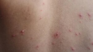 wisconsin-officials-warn-of-measles-exposure-at-travel-centers