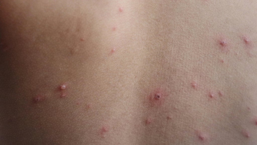 wisconsin-officials-warn-of-measles-exposure-at-travel-centers