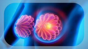 landmark-study-unveils-genomic-insights-into-triple-negative-breast-cancer