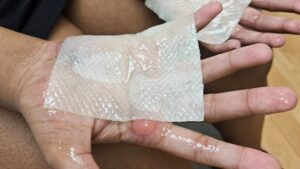 parents-demand-accountability-after-students-suffer-burns-in-practice