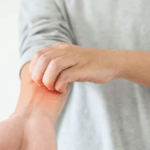 study-confirms-venom-immunotherapy-is-safe-and-effective-for-children