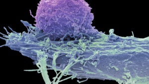 car-t-therapies-show-promise-in-treating-autoimmune-disorders