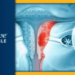 high-aneuploidy-scores-linked-to-poor-immunotherapy-outcomes