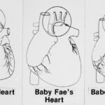 newborn-receives-baboon-heart-in-historic-transplant-oct-26