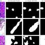 ai-tool-enhances-breast-cancer-diagnosis-with-greater-accuracy