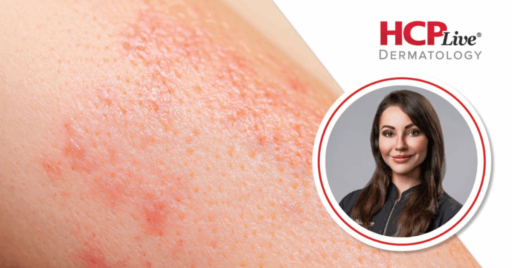 dermatologists-explore-off-label-jak-inhibitors-at-sdpa-conference