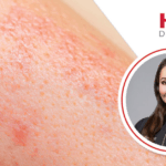 dermatologists-explore-off-label-jak-inhibitors-at-sdpa-conference