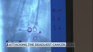 savannah-doctors-harness-cutting-edge-robotics-to-combat-lung-cancer