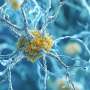 study-links-higher-alzheimer-s-risk-to-amyloid-pet-levels