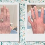 urgent-update-hand-fillers-transform-aging-appearance-instantly