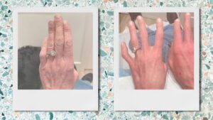 urgent-update-hand-fillers-transform-aging-appearance-instantly