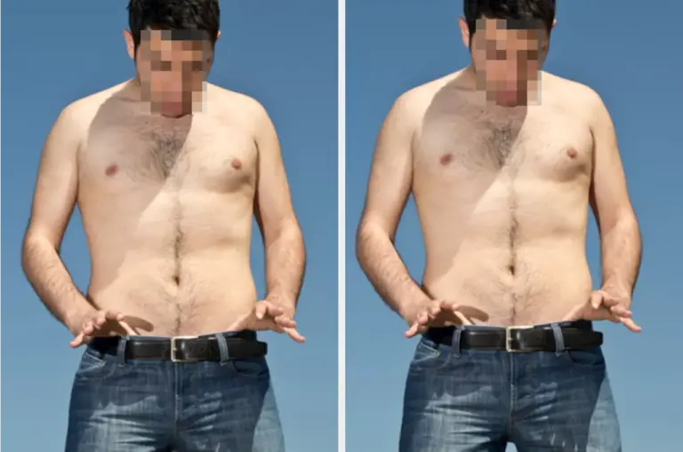 younger-men-drive-surge-in-vasectomy-interest-post-dobbs-ruling