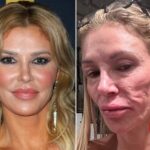 brandi-glanville-diagnosed-with-face-parasite-after-years-of-struggle