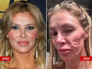 brandi-glanville-diagnosed-with-face-parasite-after-years-of-struggle