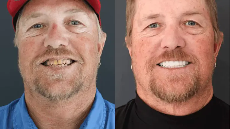 discover-the-comfort-of-dental-implants-myths-debunked