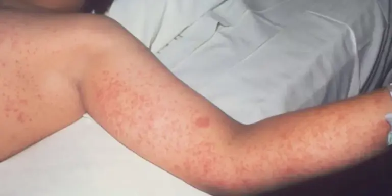 doctors-urge-awareness-of-measles-symptoms-amid-outbreaks