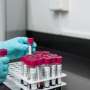 new-blood-test-promises-early-detection-of-alzheimer-s-disease