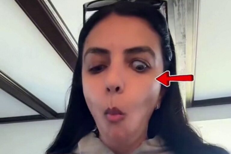 woman-embraces-rare-condition-that-causes-eye-to-bulge-while-eating