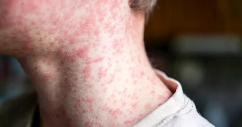 riverside-county-reports-first-measles-case-of-2026